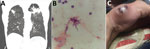 Pulmonary and cutaneous manifestations of Nocardia otitidiscavarium infection in a man in Gainesville, Florida, USA, 2020. A) Computed tomography of the chest showing progressive disease in the upper lobes. B) Bronchoalveolar lavage sample (Gram stain) showing gram-positive branching rods. C) Cutaneous abscess on the ulnar aspect of the right hand.
