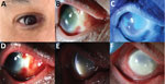Clinical progression of ocular mpox in patient in California, USA. A) Initial manifestation of nasal scleral inflammation. B) Nasal scleral necrosis with surrounding scleritis. C) Corneal epithelial sloughing. D) Worsening scleritis and nasal keratitis. E) Corneal endothelial inflammatory plaque. Nasal area of corneal irregularity represents the area of biopsy. F) Progression of diffuse keratitis and corneal limbitis. 