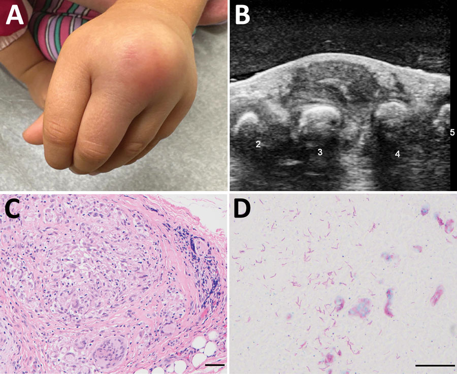 Gross and microscopic features of a mass involving the dorsum of the left hand in a 3-year-old girl with Mycobacterium marinum infection after iguana bite in Costa Rica. A) Erythematous lump over third and fourth digits. B) Ultrasound image, with numbers labeling the digits. C) Hematoxylin and eosin–stained soft tissue showing granulomatous inflammation. Scale bar indicates 10 µm. D) Fite stain highlighting numerous mycobacteria in an area of necrosis. Scale bar indicates 20 µm.