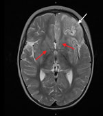 Magnetic resonance imaging of the brain of an immunocompromised child with avian paramyxovirus type 1 infection, Australia. Image, captured 16 days after hospital admission, shows predominantly left frontal and insular T2 signal hyperintensity evolving into laminar necrosis (white arrow) and hyperintensity of deep gray-matter structures (red arrows).