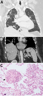Early testing conducted during investigation of illness in a 64-year-old woman from southeastern New South Wales, Australia, who was later determined to have Ophidascaris robertsi nematode infection. A) Computed tomography scan of chest with venous contrast demonstrating multiple bilateral airspace opacities and nodules with a peripheral bronchovascular distribution. The opacities have surrounding ground-glass changes. Many were present in the patient’s study from a previous hospitalization; however, some had resolved while others were new, indicating a migratory pattern. B) Computed tomography scan of abdomen with venous contrast demonstrating multiple ill-defined hypoattenuated lesions within the liver and spleen. C) Hematoxylin and eosin stain (original magnification ×200) of a pulmonary lesion revealing prominent eosinophil infiltration of stroma and vessel walls. Arrow indicates a granuloma composed of histiocytes and eosinophils. The prominent eosinophilia was inconsistent with hypersensitivity pneumonitis, and the absence of vessel wall damage did not support a diagnosis of eosinophilic granulomatosis with polyangiitis.