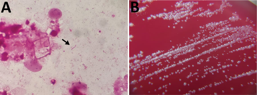 Detection and colonization of Desulfovibrio desulfuricans in an 84-year-old man in Japan who had undergone endovascular aortic repair 9 years earlier. A) Gram stain of pus. D. desulfuricans MB has a gram-negative spiral rod appearance (arrow). Original magnification ×1,000. B) Colonies of D. desulfuricans MB on ABHK agar. Biochemical properties showed positive results for catalase and negative for indole and urease. In vitro susceptibility testing revealed that it had the following MICs: meropenem, <2 μg/mL; cefotaxime, <2 μg/mL; ampicillin/sulbactam, <4 μg/mL; piperacillin/tazobactam, <16 μg/mL; and clindamycin, >8 μg/mL.