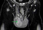 Computed tomography of patient who had human tularemia epididymo-orchitis caused by Francisella tularensis subspecies holartica, Austria. Coronal image shows the right testicle (arrow) during the arterial phase with hyperperfusion and nonperfused areas (abscess).