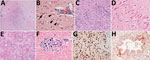 Histopathology of lesions in red foxes naturally infected with highly pathogenic avian influenza virus, United States. A) Throughout the brain, there are multifocal regions of necrosis and hypercellularity. Original magnification ×4. B) Within the gray matter, there is prominent neuronal necrosis (arrowheads), satellitosis (arrow), and reactive astrocytes. A vessel is surrounded by lymphocytes and plasma cells. Original magnification ×4. C) In areas of necrosis within the brain, there is often abundant, stippled, basophilic karyorrhectic debris. Original magnification ×40. D) Within the hippocampus, there are numerous shrunken, angular, and acidophilic (necrotic) neurons in a laminar pattern. Original magnification ×20. E) Within the lung, there is diffuse vascular congestion. Alveoli contain fibrin, hemorrhage, and edema fluid. Original magnification ×20. F) Regions of cardiomyocyte necrosis in the heart are often mineralized. Original magnification ×40. Panels A‒F, hematoxylin and eosin stain.G) Within the brain, there is positive nuclear and cytoplasmic staining of neuron cell bodies and processes. Avian influenza virus monoclonal immunohistochemical analysis. Original magnification ×40. H) Scattered positive nuclear and cytoplasmic staining of bronchiolar epithelial cells and interstitial macrophages in the lung. Monoclonal immunohistochemical analysis of influenza A virus nucleoprotein. Original magnification ×40. 