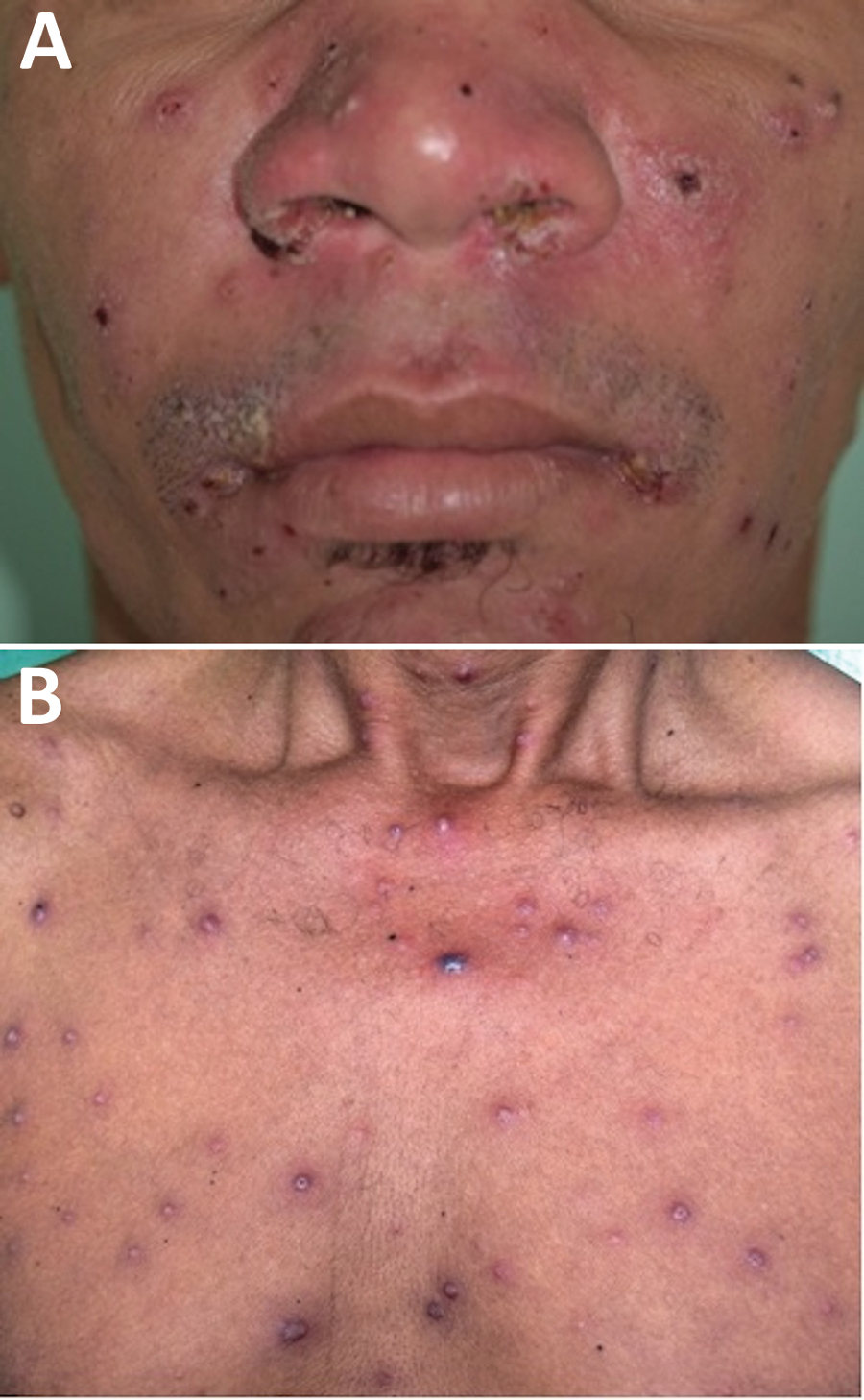 Clinical manifestation of disseminated leishmaniasis in male patient with multiple acneiform lesions, inflammatory and crusted papules in the face (A) and trunk (B), Brazil.