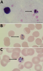 Peripheral thick and thin blood smears of a man in British Columbia, Canada, with suspected Plasmodium knowlesi infection after travel to the Phillippines. A) Thick smear showing P. knowlesi gametocyte.. B) Thin smear showing band form within a normal-sized, fimbriated erythrocyte with vacuoles present, similar to P. malariae. C) Thin smear showing P. knowlesi schizont form with presence of greenish-black pigment and lack of rosette formation. Original magnification x100 for all smears.