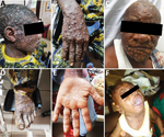 Maculopapular lesions in mpox patients from a study of concurrent clade I and clade II monkeypox virus circulation, Cameroon, 1979–2022. A–E) Deep maculopapular lesions of different sizes spread from the head (A, C) to hands (B) and diffuse to the soles of the feet (D) the palm of the hand (E). F) Lesions, including oral lesions and mouth ulcers, in a 3-month-old male baby.
