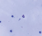Pericardial fluid smear collected for diagnosis of acute Chagas disease among military personnel, Colombia, 2021. Giemsa-stained pericardial fluid smear of patient 1 shows a Trypanosoma cruzi parasite (center). Original magnification ×1,000.