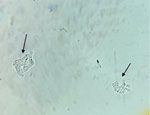Two trophozoites with pseudopod formation identified during microscopic examination of cerebrospinal fluid from a 22-year-old man later diagnosed with Naegleria fowleri infection, Karachi, Pakistan, 2023. Original magnification ×40.