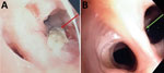 Macroscopic observation of endobronchial Microascus cirrosus lesion in patient in France with refractory microascus bronchopulmonary infection before (A) and after (B) olorofim treatment. Arrows indicate the lesion.