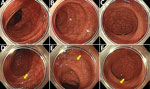 Colonoscopy findings from a man in Japan who had recurrent Helicobacter fennelliae bacteremia. A–C) First colonoscopy findings in the transverse colon (A), in the sigmoid colon (B), and in the rectum (C). D–F) Second colonoscopy findingsin the transverse colon (D), in the sigmoid colon (E), and in the rectum (F). Yellow arrows indicate randomly biopsied sites. Colonic vascular permeability was preserved, and there were no significant findings for inflammation. 