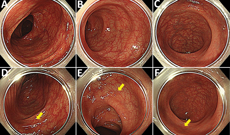 Colonoscopy findings from a man in Japan who had recurrent Helicobacter fennelliae bacteremia. A–C) First colonoscopy findings in the transverse colon (A), in the sigmoid colon (B), and in the rectum (C). D–F) Second colonoscopy findingsin the transverse colon (D), in the sigmoid colon (E), and in the rectum (F). Yellow arrows indicate randomly biopsied sites. Colonic vascular permeability was preserved, and there were no significant findings for inflammation. 
