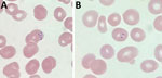 Representative thin blood smears showing Plasmodium falciparum in pregnant patient, Washington County, Oregon, USA, July–September 2022. Ring-form trophozoites, morphologically consistent with P. falciparum, were identified. A) Multiply-infected erythrocyte showing an applique form; B) ring form showing 2 chromatin dots (headphone form). Original magnification x1,000.