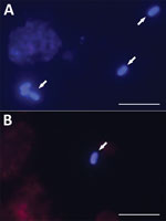 Microscopic analysis of Encephalitozoon cuniculi spores isolated from immunocompetent patients in study of microsporidia in patients with degenerative hip and knee disease, Czech Republic. Samples were collected from patients who tested positive for Encephalitozoon DNA during May 2020–September 2021 at Bulovka Hospital in Prague. Visualization of E. cuniculi from sample of knee joint fluid from patient no. 29 (A) and hip joint fluid from patient no. 2 (B). Arrows indicate E. cuniculi spores stained with Calcofluor M2R (Sigma Aldrich, https://www.sigmaaldrich.com) and viewed after fluorescence excitation at 490 nm wavelength. Scale bars are 10 μm.