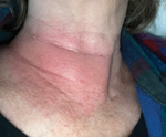Erythematous rash on the right side of the neck of a patient with Lyme disease, central North Carolina, USA.