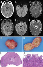 Diagnostic imaging of the brain and cystic lesion resected from boy with neurocysticercosis-like lesion, the Netherlands. A) Axial computed tomography showing edema in the left temporal lobe with a barely visible hypointense round lesion with a noncalcified, isointense rim (arrow). B–F) Axial magnetic resonance images at slightly different levels through the cystic lesion with surrounding edema in the left temporal lobe, showing a hypointense ring on susceptibility-weighted image (B) using minimum intensity projection (arrow) and on T2-weighted image (C), suggestive of a fibrotic capsule. D) Three-dimensional T1-weighted image showing a slightly irregular enhancement of the rim. E, F) On diffusion-weighted image (E) and apparent diffusion coefficient map (F), the rim is isointense and central diffusion restriction is absent, excluding a bacterial abscess. G, H) Macroscopic picture of the lesion showing a round nodule (G) and a cyst-like lesion (H) on cut section with a white-greyish central area surrounded by a thin capsule. I, J) Microscopic images showing a necrotic core (1) surrounded by a rim of fibrosis (2) and a mixed inflammatory response (3) (I) and multinuclear foreign-body-type giant cells (J).