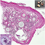 Results of testing in a 24-year-old Black woman with rhinosporidiosis, South Africa. Squamous mucosa with numerous thick-walled sporangia in the subepithelial region amid subacute inflammation. Hematoxylin and eosin stained section; original magnification ×100. Upper right inset shows polypoid solid fragments of tissue; lower left inset depicts sporangia enclosing endospores maturing centripetally (white arrow). Insets: original magnification ×200.