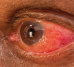 Left eye of a patient who recently migrated to Australia and originated from Sri Lanka, showing a subconjunctival infection that was identified as Dirofilaria sp. Hong Kong genotype nematode. The nematode can be seen at 3–5 o’clock, adjacent to the limbus of the eye.
