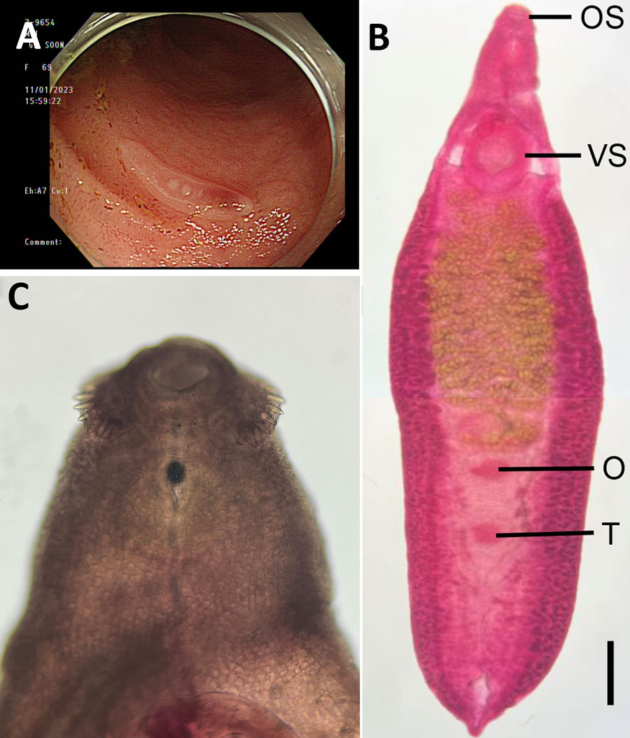 Analysis of a worm identified as Echinostoma cinetorchis removed during colonoscopy from a 69-year-old woman in South Korea. A) Colonoscopy image showing a moving trematode in the mucosa of the descending colon. B) Whole body of the worm. Scale bar = 0.6 mm. C) Head part of the worm showing collar spines (37 in total number) on the head collar around the oral sucker, by which it could be morphologically identified as a 37-collar-spined echinostome. Scale bar = 0.1 mm). OS, oral sucker; VS, ventral sucker; O, ovary; T, testis. 