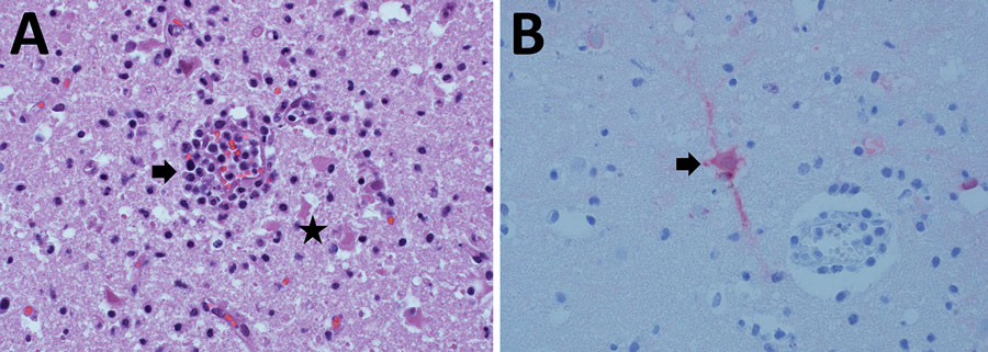 Histologic analysis of brain tissue from a dead free-ranging polar bear infected with highly pathogenic avian influenza virus A(H5N1) clade 2.3.4.4b, Alaska, USA. A) Hematoxylin and eosin staining of brain tissue section showing meningoencephalitis. Arrow indicates mixed inflammatory cells within and around blood vessels and hypertrophied vascular endothelial cells. Star indicates necrotic neurons and increased number of microglial cells within the parenchyma. Original magnification ×400. B) Arrow indicates influenza A virus within the neuronal perikaryon (red staining) observed by immunohistochemistry of formalin-fixed paraffin-embedded brain sections. Original magnification ×400.