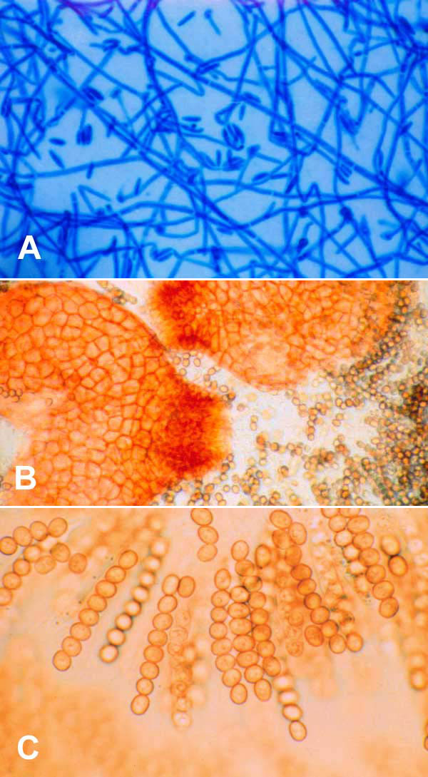 A) Neocosmospora vasinfecta after 4 days' subculture on Sabouraud agar (lactophenol cotton blue stain, x400). B) N. vasinfecta perithecial ascomata after 4 weeks on oatmeal agar with lupine stem (x160). C) Asci with ascospores of N. vasinfecta (x400).