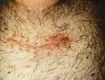 Thumbnail of Surgical site infection following minimally invasive valve surgery.