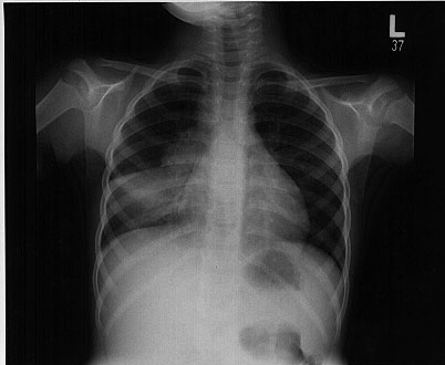 Chest radiograph of a girl with pulmonary tuberculosis. Note the significant hilar adenopathy in association with atelectasis, the so-called collapse-consolidation lesion.