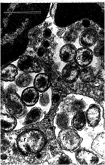 Human granulocytic ehrlichiae (BDS strain) in an equine peripheral blood nneutrophil are located within four morulae. Reticulate (r) and dense-cored (d) cells are surrounded by two membranes: cell wall membrane and cytoplasmic membrane. Bar = 1 µm; magnification, x 27,000. (Courtesy of Vsevolod Popov, University of Texas Medical Branch at Galveston.)