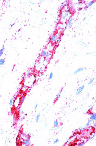 Immunostaining of Ebola virus antigens (red) within vascular endothelial cells in skin biopsy of the chimpanzee found dead in the forest near Booué. Note also the presence of extracellular viral antigens. (Rabbit anti-Ebola virus serum, napthol/fast red with hematoxylin counterstain, original magnification x250).