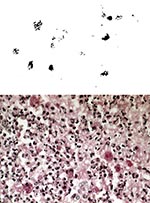 Thumbnail of A. Bronchial tissue Gram stain showing intrahistiocytic coccobacillary forms of Rhodococcus equi. Original magnification, x 1,000. B.Open lung biopsy showing coalescent microabscesses with numerous histiocytes containing Rhodococcus equi organisms. PAS stain. Original magnification x 250. Figure provided by Dr. Margie Scott, Vanderbilt University Medical Center.