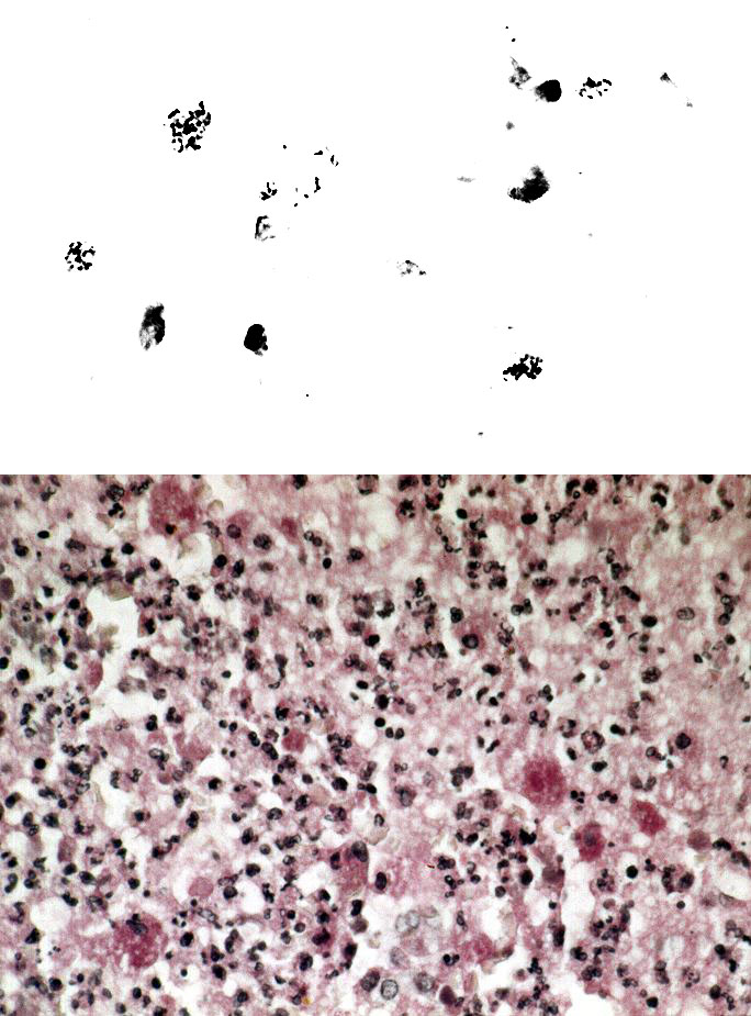 A. Bronchial tissue Gram stain showing intrahistiocytic coccobacillary forms of Rhodococcus equi. Original magnification, x 1,000. B.Open lung biopsy showing coalescent microabscesses with numerous histiocytes containing Rhodococcus equi organisms. PAS stain. Original magnification x 250. Figure provided by Dr. Margie Scott, Vanderbilt University Medical Center.