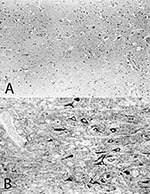 Thumbnail of Immunohistologic analysis of consecutive brain sections from the cerebral cortex of horse #215 with A) the monoclonal antibody Bo18, specific for the p38/p39 BDV-protein and B) a rabbit monospecific serum, specific for the p24 BDV-protein. Immunoreactive neurons are only detected with the p24-specific antiserum. Papa-nicolaou-counterstain, x130.