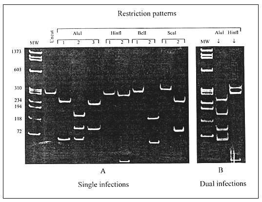 Differentiation between single (A) and dual (B) HIV-1 infections by the restriction fragment length polymorphism analysis of the polymerase chain reaction—amplified prt. A: Three AluI digestion patterns represent subtypes A, C, and F (pattern 1) and subtypes B and D (patterns 2 and 3); two HinfI patterns represent subtypes D (pattern 1) and B (pattern 2); two BclI patterns represent subtypes F (patterns 1) and A and C (pattern 2); two ScaI patterns represent subtypes A (pattern 1) and C (pattern