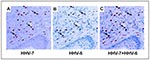 Thumbnail of Expression of human herpesvirus 6B (HHV-6B) and HHV-7 antigens in serial sections of Kaposi sarcoma specimens. Panels A-C: In Kaposi sarcoma environment, cells can be doubly infected by HHV-6B and HHV-7: (A) Staining with monoclonal antibody 5E1 to HHV-7-specific antigen pp85; (B) Staining with monoclonal antibody to HHV-6B-specific antigen p101; (C) Overlaid serial sections show colocalization of HHV-6B and HHV-7 (71).