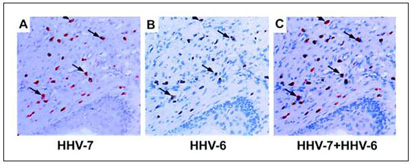 Expression of human herpesvirus 6B (HHV-6B) and HHV-7 antigens in serial sections of Kaposi sarcoma specimens. Panels A-C: In Kaposi sarcoma environment, cells can be doubly infected by HHV-6B and HHV-7: (A) Staining with monoclonal antibody 5E1 to HHV-7-specific antigen pp85; (B) Staining with monoclonal antibody to HHV-6B-specific antigen p101; (C) Overlaid serial sections show colocalization of HHV-6B and HHV-7 (71).