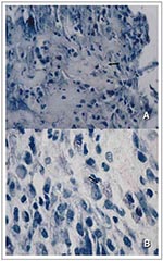 Thumbnail of Active disease histopathologic sections of soft tissue stained for acid-fast bacilli from a patient with a Mycobacterium marinum infection. In A, the arrow indicates localized necrosis, and in B, the arrow indicates predominance of intracellular bacilli.  (Slide courtesy of Arthur B. Abt and Leslie Parent, Penn State Geisinger Health System and Pennsylvania State University College of Medicine, Hershey Medical Center, Hershey, Pennsylvania.)