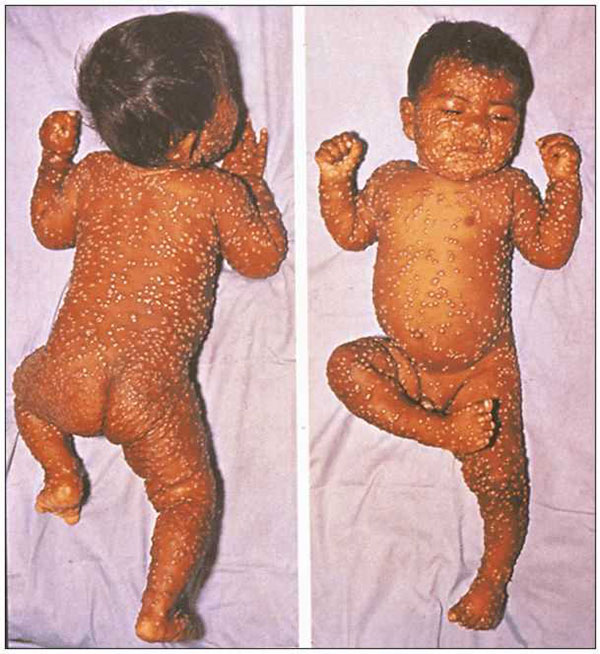 Most cases of smallpox are clinically typical and readily able to be diagnosed. Lesions on each area of the body are at the same stage of development, are deeply embedded in the skin, and are more densely concentrated on the face and extremities.