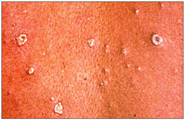 The lesions of chickenpox develop as a series of "crops" over several days and are very superficial. Papules, vesicles, pustules, and scabs can be seen adjacent to each other. The trunk is usually more affected than the face or extremities.