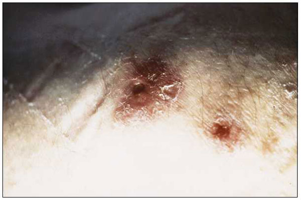 Abscesses due to Mycobacterium abscessus on the left hip of 64-year-old man who had injected (numerous times) a presumed adrenal cortex extract. The first lesion developed 9 weeks before this photograph was taken.