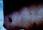 Thumbnail of Diffuse petechial rash of epidemic typhus (day 7).