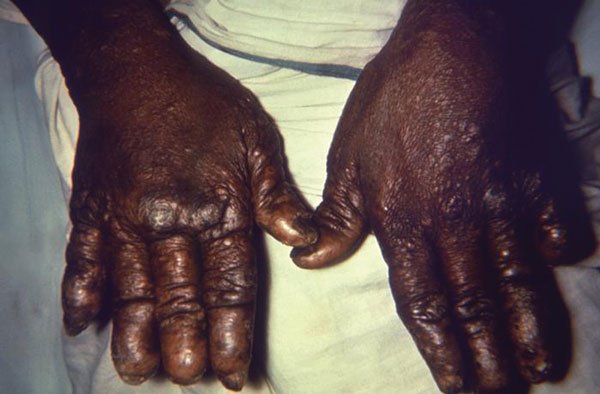 Dorsal surface of the hands of a patient with a case of nodular lepromatous leprosy, which under the newer World Health Organization (WHO) standards, is classified as multibacillary (MB), leprosy.