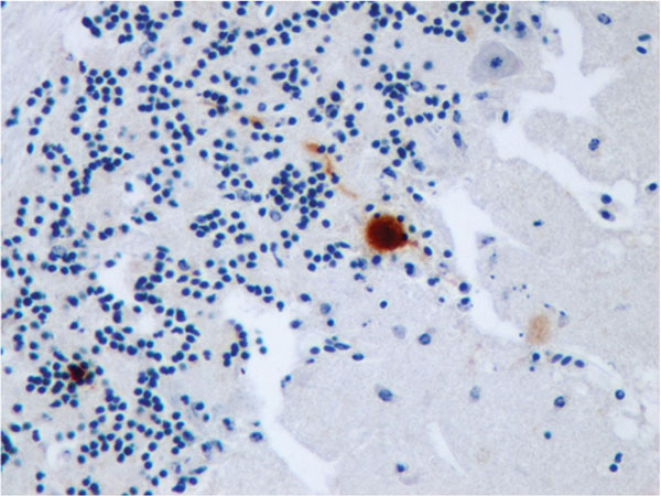 Thumbnail of Immunohistochemical staining for Usutu virus antigen in a Purkinje cell of the cerebellum of a song thrush that died of encephalitis. Original magnification ×400.