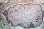 Thumbnail of Histopathology of Sparganum proliferum infection. Public Image Health Library, CDC, 1962.
