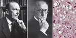 Thumbnail of (L–R) Hans Gerhard Creutzfeldt (1885–1964; Alfons Maria Jakob (1884–1931); Creutzfeldt–Jakob disease, cerebrum hematoxylin and eosin staining showing spongiform encephalophathy. Images reproduced from Foundations of Virology, 2012, courtesy Frederick A. Murphy.
