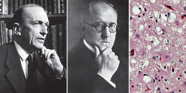 (L–R) Hans Gerhard Creutzfeldt (1885–1964; Alfons Maria Jakob (1884–1931); Creutzfeldt–Jakob disease, cerebrum hematoxylin and eosin staining showing spongiform encephalophathy. Images reproduced from Foundations of Virology, 2012, courtesy Frederick A. Murphy.