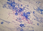 Twisted hair bacteria (Nocardia spp.) described by Edmond Nocard, from a bronchial alveolar lavage sample. Nocardiosis is an opportunistic infection, commonly associated with pulmonary disease. Nocardia are partially acid-fast, filamentous, branching bacilli (modified Kinyoun acid-fast stain using weak acid [0.5% sulfuric acid] for decolorization and methylene blue counterstain, original magnification x1,000.) Photograph courtesy of the author.