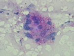 Numerous, capsulated yeast cells (shown in pink) of Histoplasma capsulatum in a bone marrow aspirate (Giemsa-stained, original magnification ×400). Source: Shivaprakash Rudramurthy, PGIMER, Chandigarh, India.